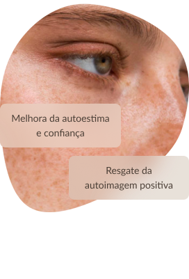 Tratamento de Melasma, resgate da autoimagem positiva
