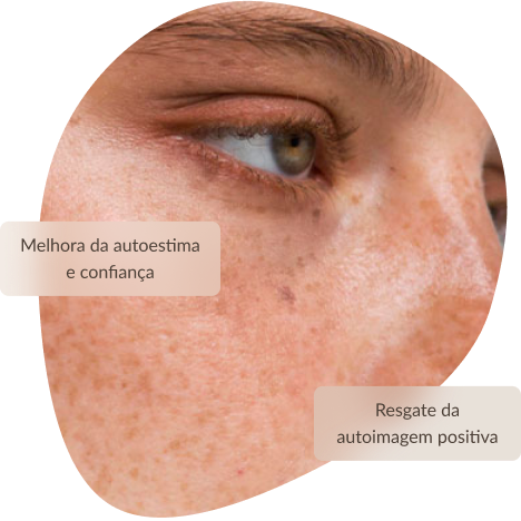 Tratamento de Melasma, melhor a autoestima