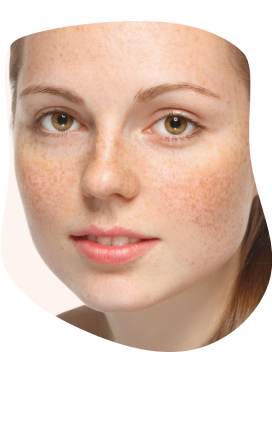 Melasma Tratamento Para Uniformizar O Tom Da Pele