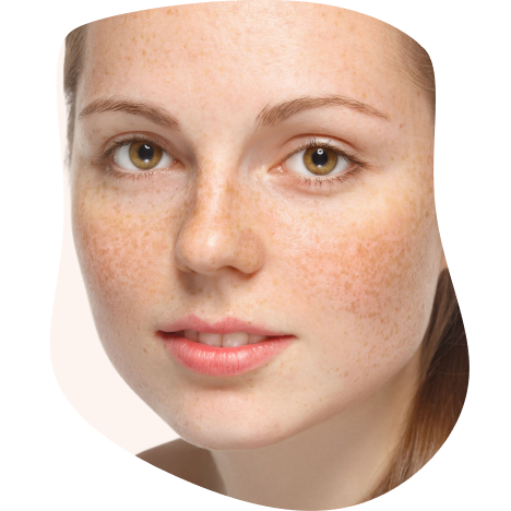 Melasma