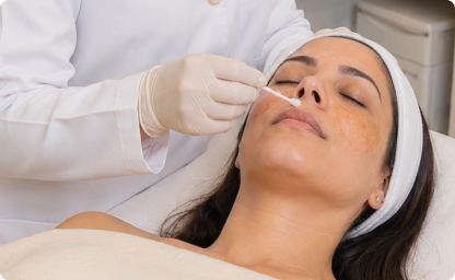 tratamento de melasma feito pela Alciara Lima dermatologista