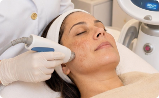 Dermatologista Alciara Lima fazendo tratamento de melasma em uma paciente